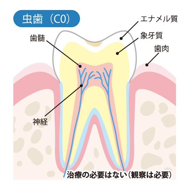かほく市の歯医者、かほくスクエア歯科口腔外科で虫歯治療