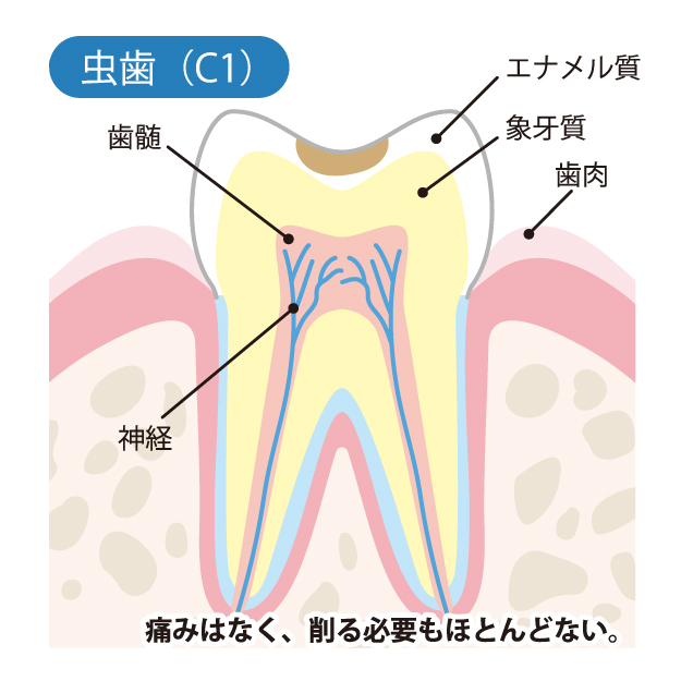 かほく市の歯医者、かほくスクエア歯科口腔外科で虫歯治療