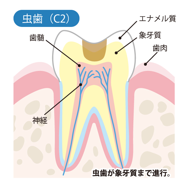 かほく市の歯医者、かほくスクエア歯科口腔外科で虫歯治療