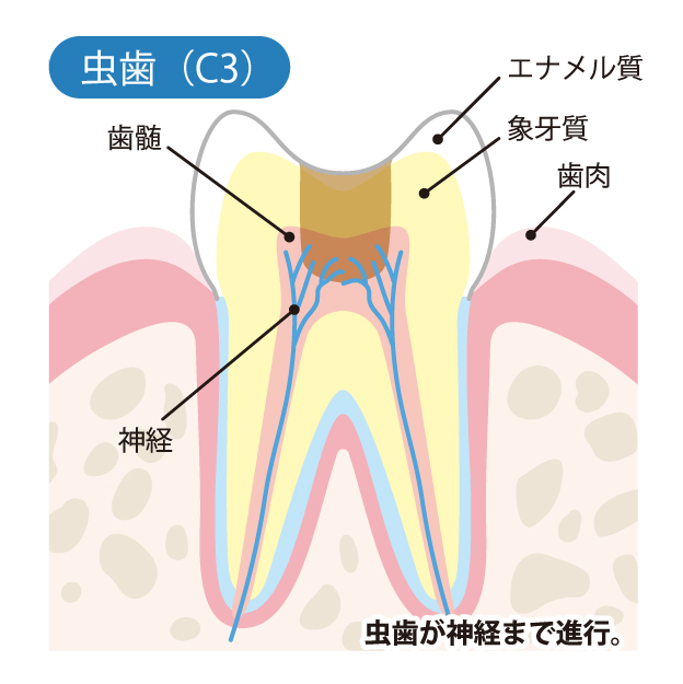 かほく市の歯医者、かほくスクエア歯科口腔外科で虫歯治療