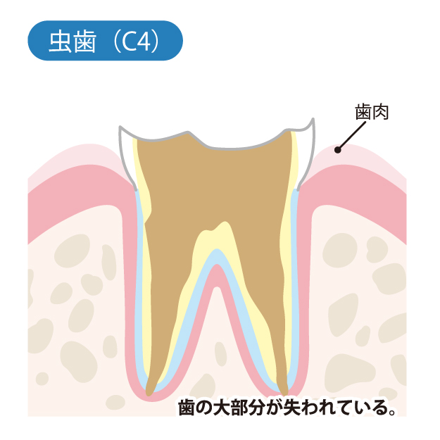 かほく市の歯医者、かほくスクエア歯科口腔外科で虫歯治療