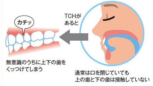 かほく市の歯医者、かほくスクエア歯科口腔外科で、顎関節症の治療
